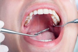 High Blood Sugar, Increased Gum Risk: Dental Concerns Alerting Diabetics
