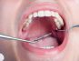 High Blood Sugar, Increased Gum Risk: Dental Concerns Alerting Diabetics