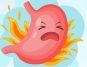Acid Reflux
