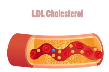 LDL Cholesterol