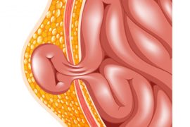 Hernia