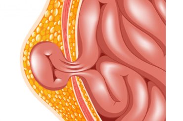 Hernia