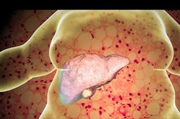 Obesity and Liver Cancer