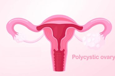 PCOS