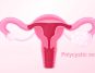 PCOS