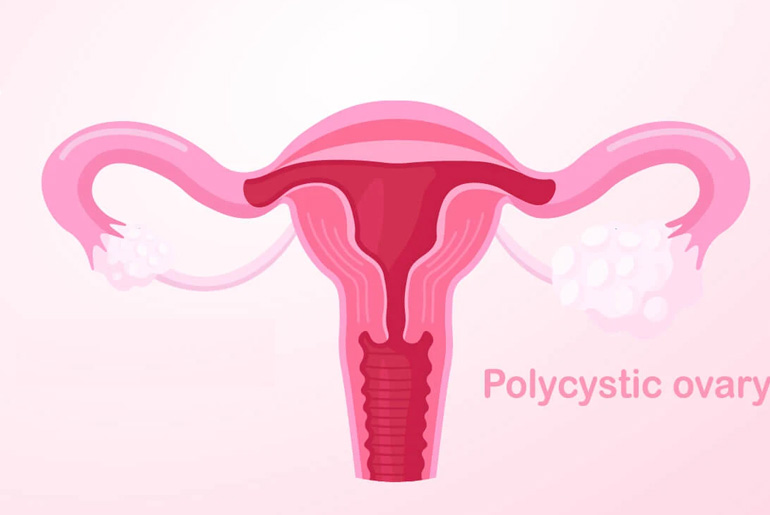 PCOS