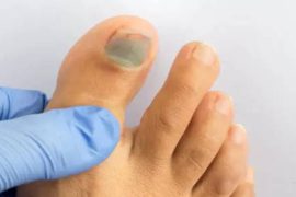 Signs of High Cholesterol