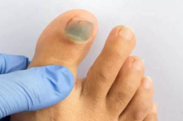 Signs of High Cholesterol